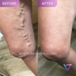 Vein diseases - blog post photo 1 Explora métodos avanzados de tratamiento para venas varicosas. Descubre opciones de vanguardia para piernas más saludables. ¡Transforma tu bienestar hoy!