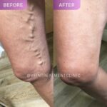 Vein diseases - blog post photo 1 Explora nuestra Guía Completa de Tratamiento para Venas Varicosas. Opciones efectivas, consejos y más para unas piernas saludables. ¡Comienza hoy!