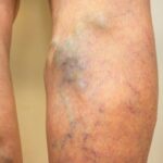 Vein diseases - blog post photo 1 Descubre cómo la ansiedad y la depresión afectan a pacientes con várices. Comprende el impacto emocional y la importancia del bienestar mental en el tratamiento.